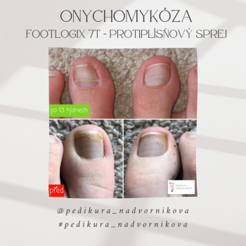 ONYCHOMYKÓZA - Plísňová onemocnění nohou